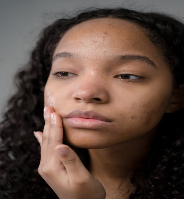 fungal acne
