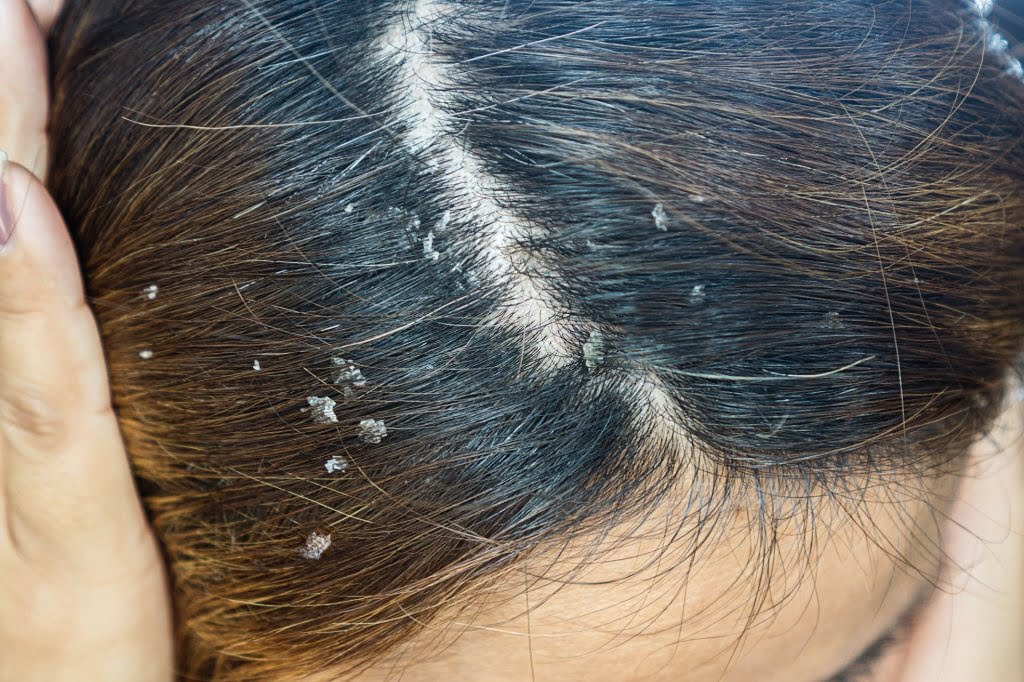 Hair with dandruff scalp, seborrheic dermatitis