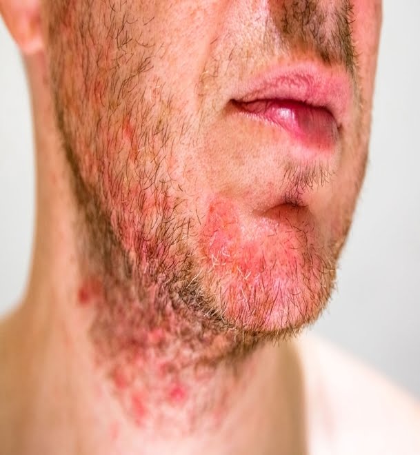 seborrheic-dermatitis-front