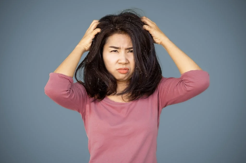 Seborrheic Dermatitis usually causes an itchy scalp