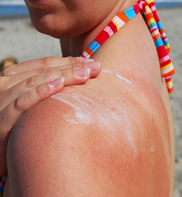 how long does sunburn last