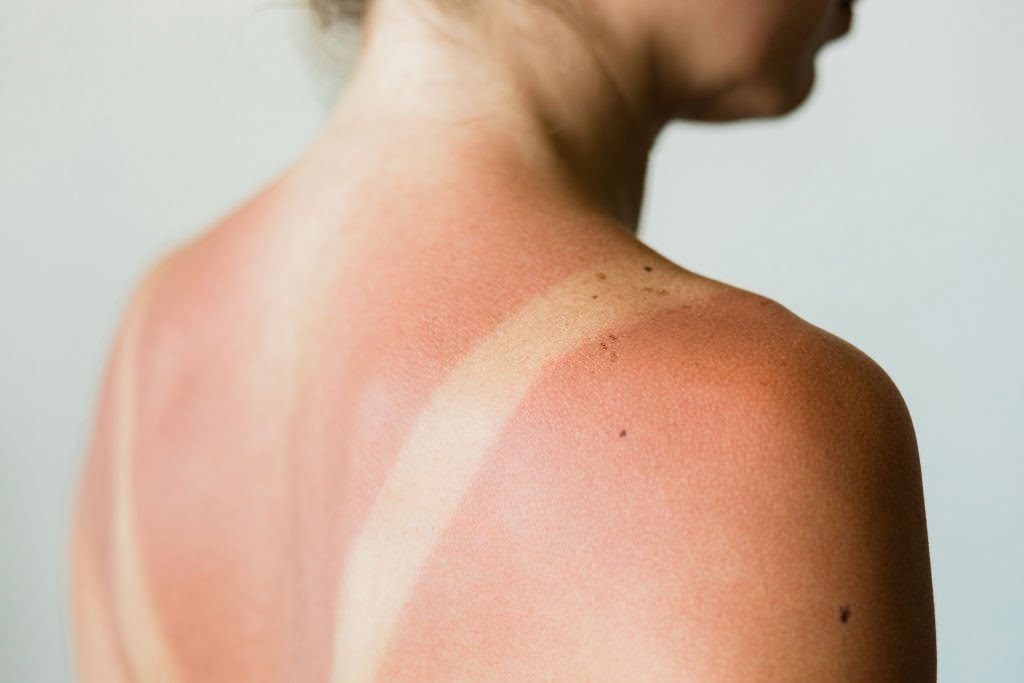 How long does sunburn last