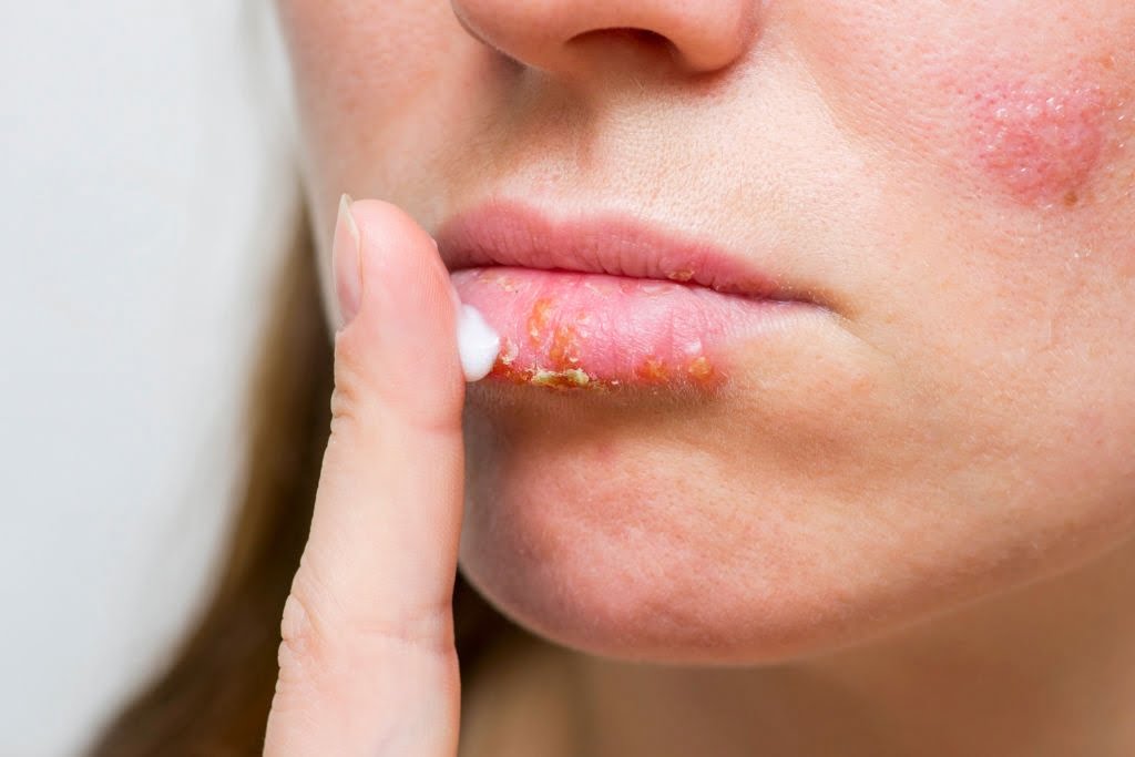 How To Treat And Prevent Sunburned Lips 5 Easy Ways